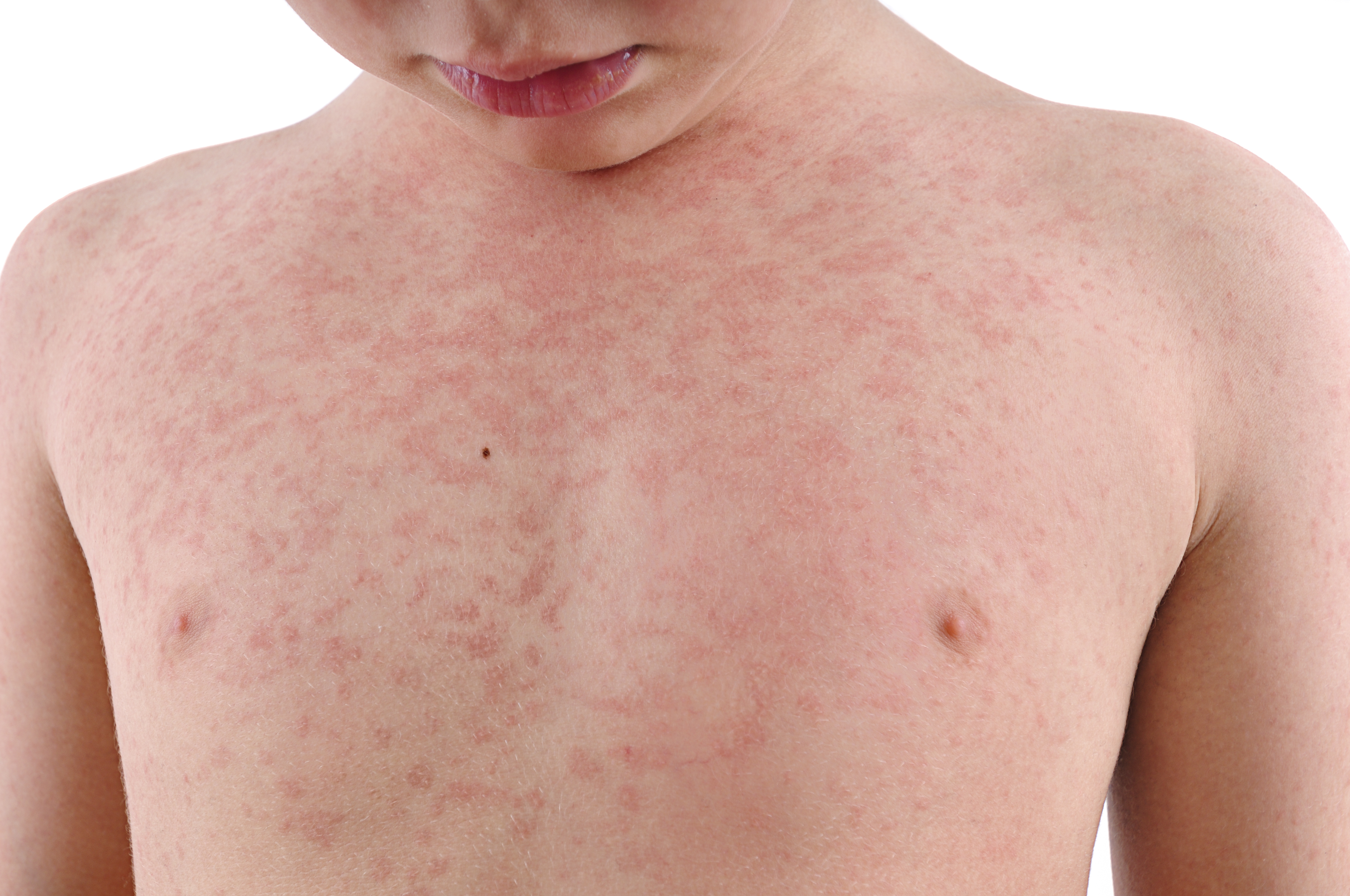 Got heat rash? Here's how to identify and treat the condition