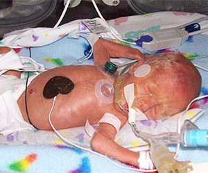 premature baby Ewan Vogelgesang in the St. Cloud NICU