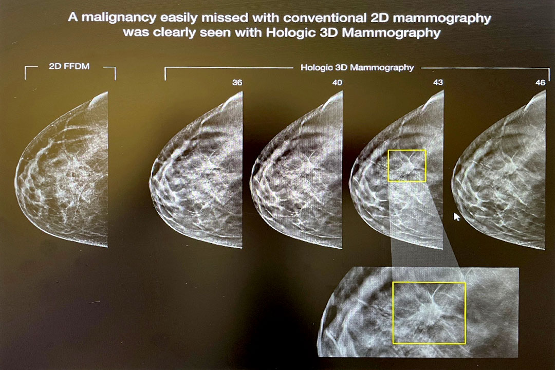 Mammograms, Breast Ultrasounds and MRI's: What's It All Mean?