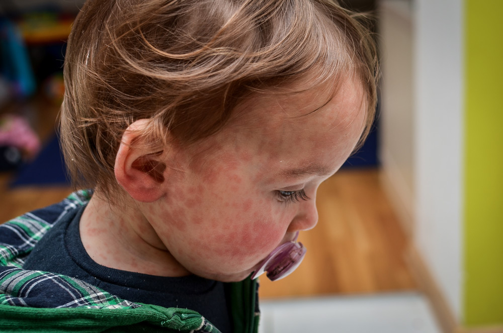 toddler with measles