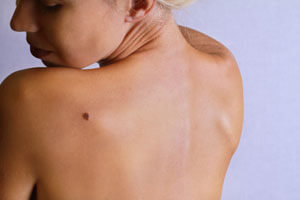 Woman looking over her shoulder at a mole on her back.