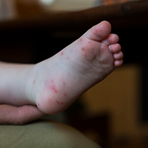 child's foot with red spots