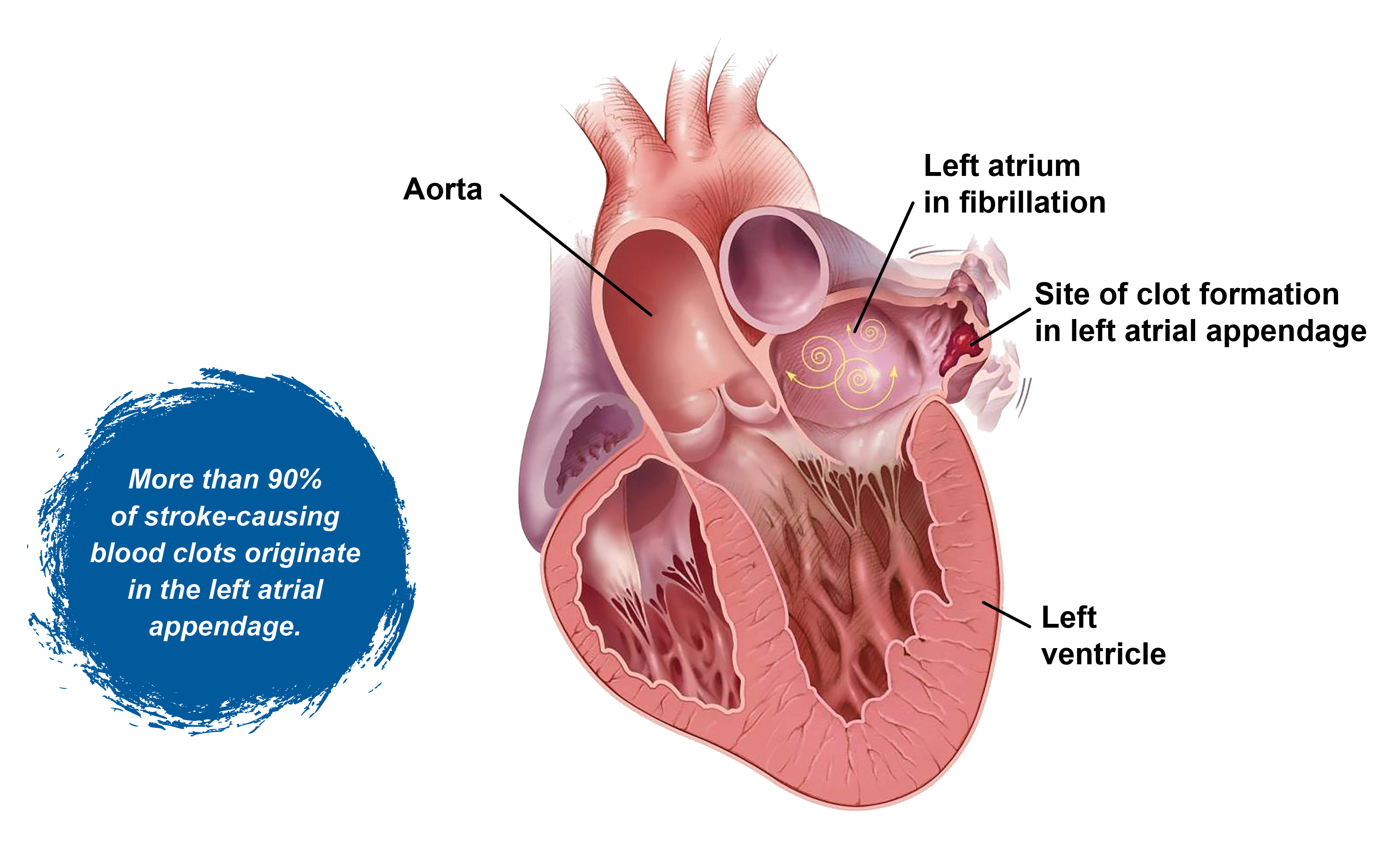 Anatomical illustration of the heart that showcases the aorta, left atrium in fibrillation, left atrial appendage and left ventricle. The image notes that more than 90% of stroke-causing blood clots originate in the left atrial appendage.