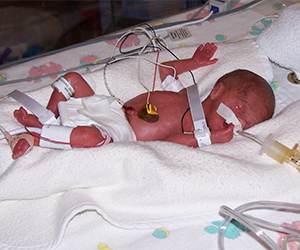 premature baby August in the St. Cloud NICU